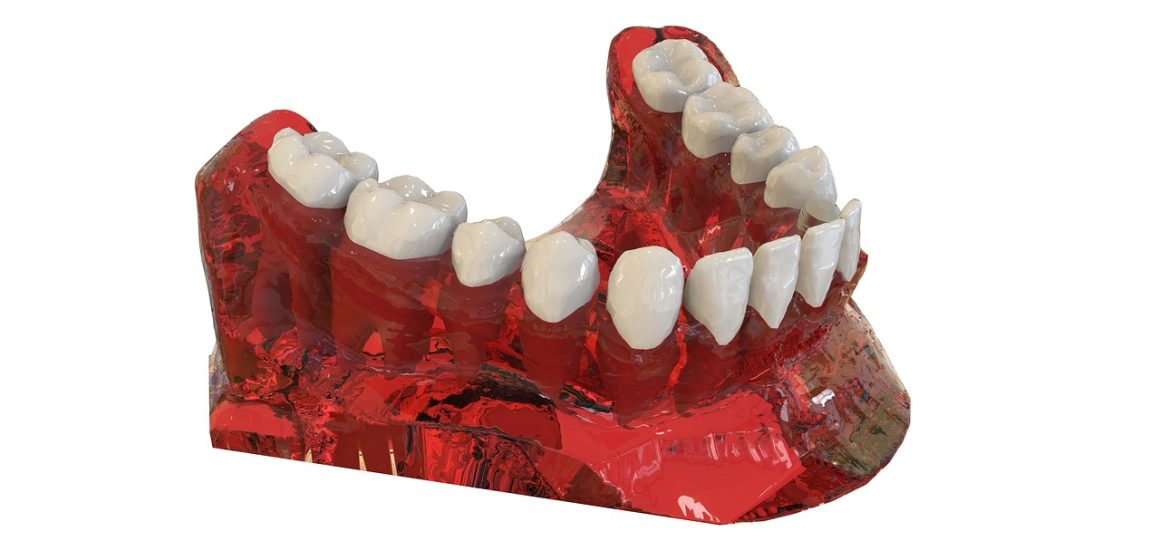 Implanty zębowe – innowacyjna metoda leczenia braków w uzębieniu
